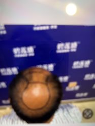 -碧莲盛·不剃发植发