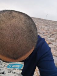 -大麦微针植发丨全国连锁