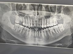 -上海仁爱医院口腔科 · 种植