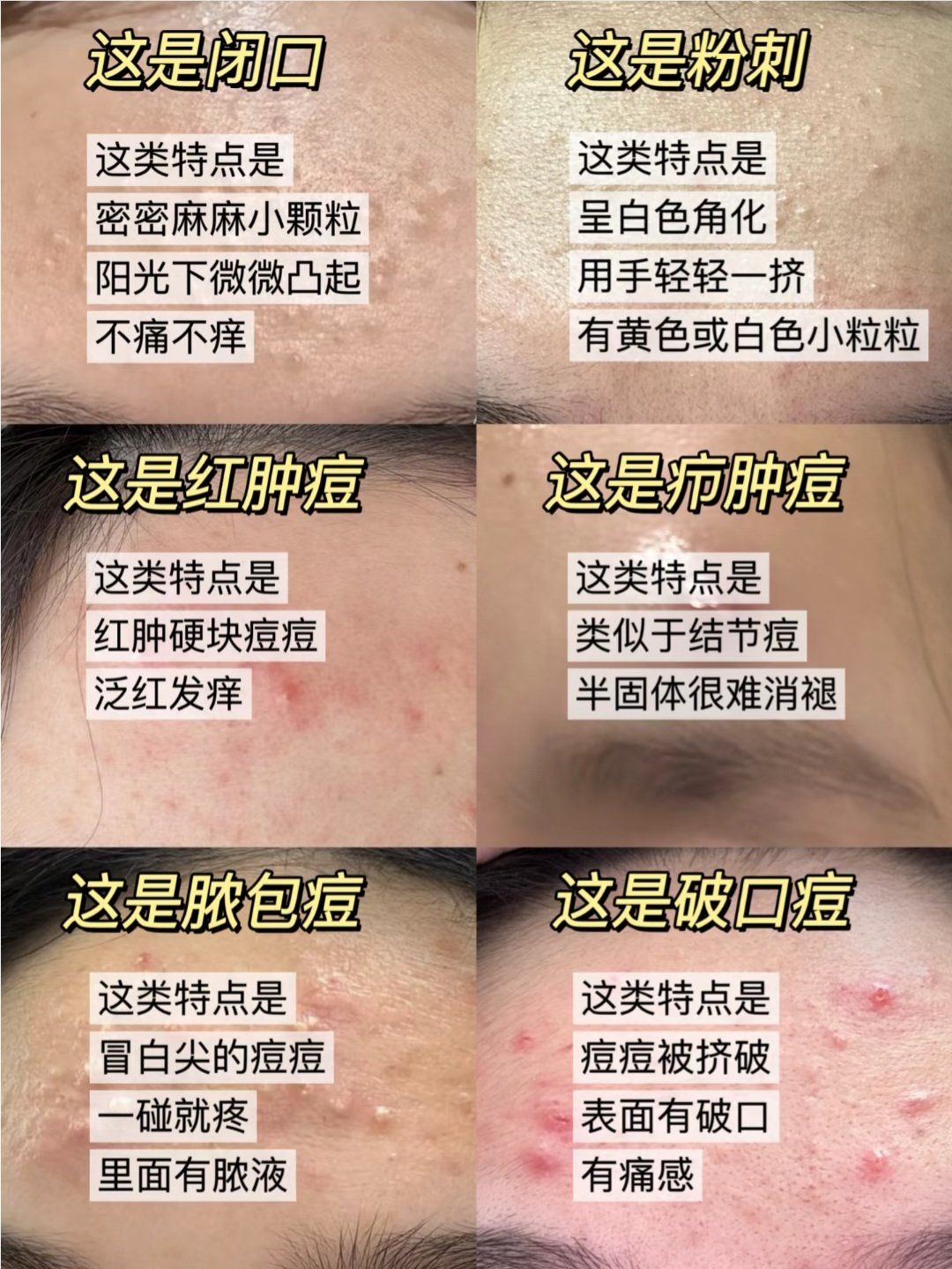 一篇看懂痘痘类型