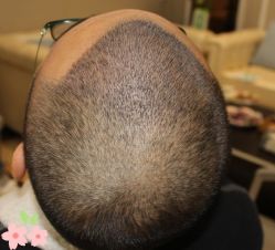 -大麦微针植发丨全国连锁