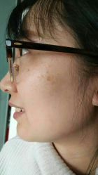 -美丽人生祛斑扁平疣汗管瘤中心