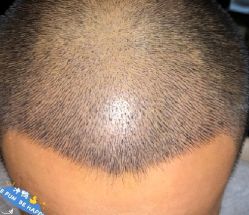 -大麦微针植发丨全国连锁