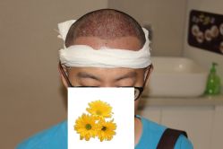 -大麦微针植发丨全国连锁