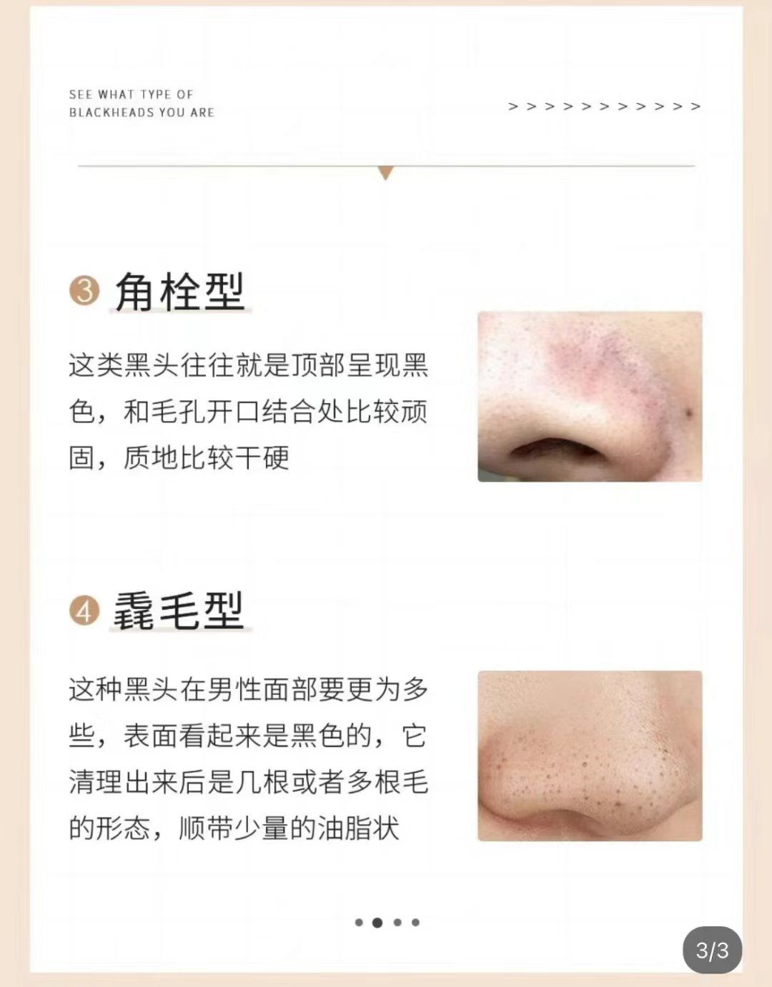 看看自己是哪种类型的黑头?
脂栓型