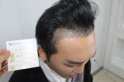 点击看大图 -大麦微针植发丨全国连锁