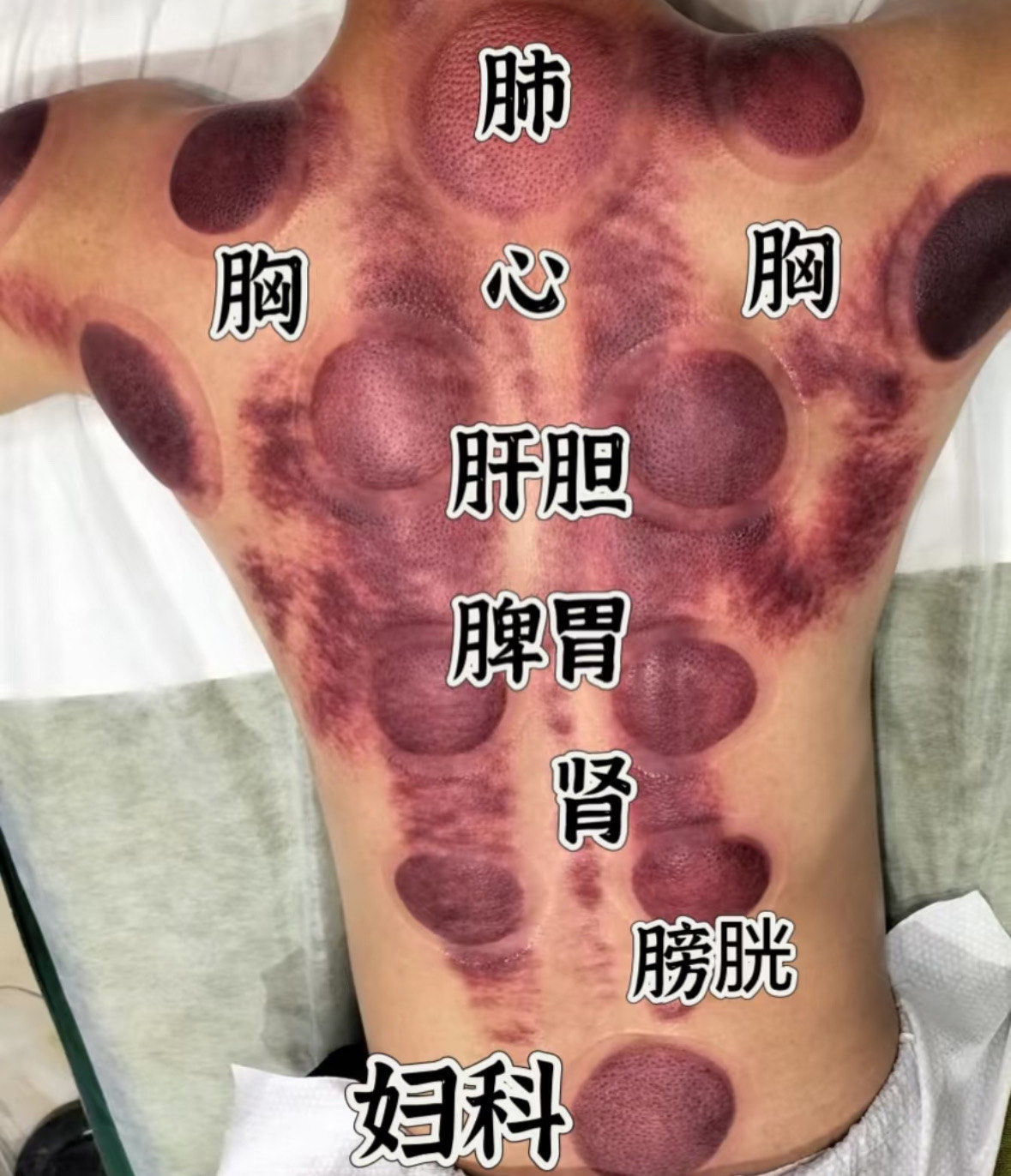 今天你刮痧了吗