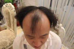 点击看大图 -大麦微针植发丨全国连锁