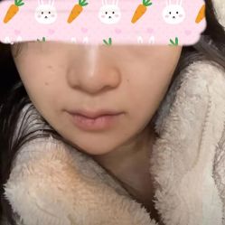 体验后-东剑医学美容·注射美学中心