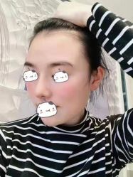 体验后-成都西区医院整形美容