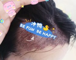 -大麦微针植发全国连锁