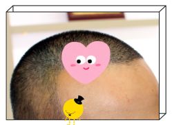 -大麦微针植发全国连锁