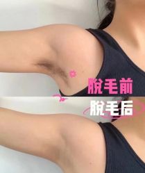 -HEYAN荷妍专业脱毛连锁机构