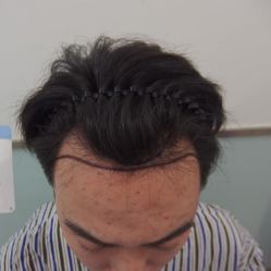 点击看大图 -碧莲盛·不剃发植发