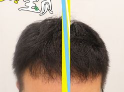 -大麦微针植发全国连锁