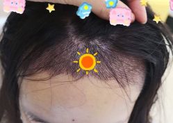 -大麦微针植发全国连锁