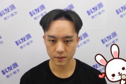 -大麦微针植发丨全国连锁