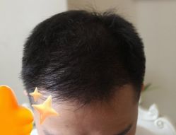 -大麦微针植发丨全国连锁