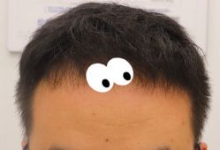 -大麦微针植发全国连锁