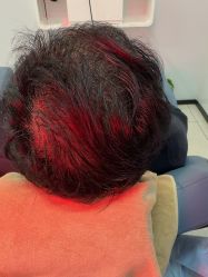 -大麦微针植发丨全国连锁