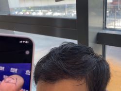 -碧莲盛·不剃发植发