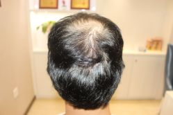 -大麦微针植发丨全国连锁