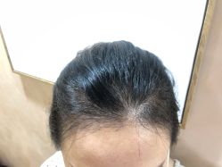 体验后-熙朵美学植发连锁
