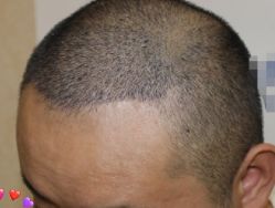 -大麦微针植发丨全国连锁