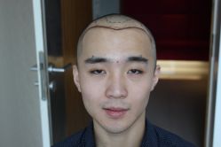 点击看大图 -大麦微针植发丨全国连锁