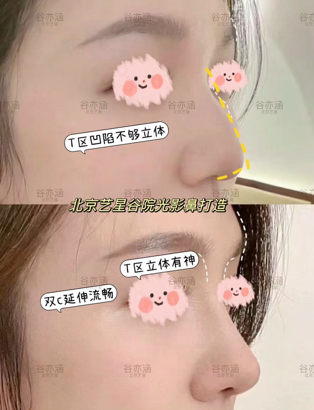 74大鼻头 74宽鼻背的宝子们看过来98
想do鼻,又不想动刀92