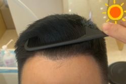 -大麦微针植发丨全国连锁