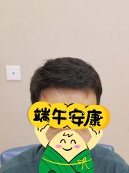 体验后-大麦微针植发丨全国连锁
