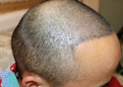 -大麦微针植发丨全国连锁