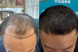 -碧莲盛·不剃发植发