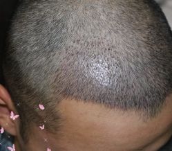 -大麦微针植发丨全国连锁