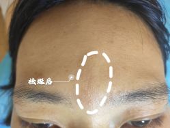 -爱莎扁平疣·汗管瘤·斑痣中心