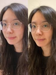 体验后-北京米扬丽格医疗美容·联合丽格鼻整形中心