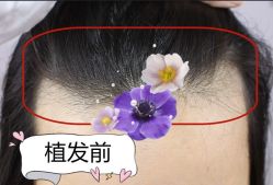 -大麦微针植发全国连锁