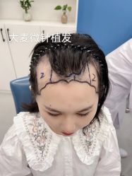 体验前-大麦微针植发全国连锁