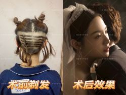 点击看大图 -熙朵美学植发连锁
