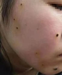 -北京美痣堂古方祛痣斑疣瘊