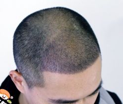 -大麦微针植发丨全国连锁