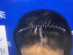 体验后-雍禾植发全国连锁