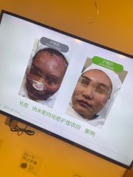-塑青春&伊肤泉祛痘皮肤管理