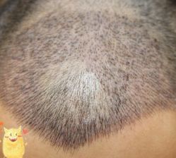 -大麦微针植发丨全国连锁