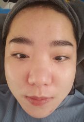 体验前-More摩尔医美の注射线雕光电中心