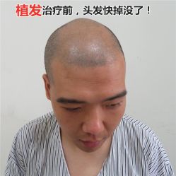-碧莲盛·不剃发植发