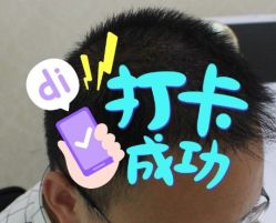 -大麦微针植发全国连锁