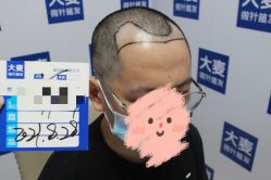 体验前-大麦微针植发丨全国连锁