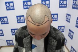 -大麦微针植发丨全国连锁